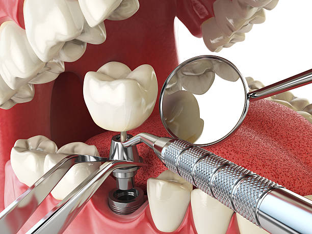 Best Emergency Dental Care for Broken or Chipped Teeth in Rlsbad, CA